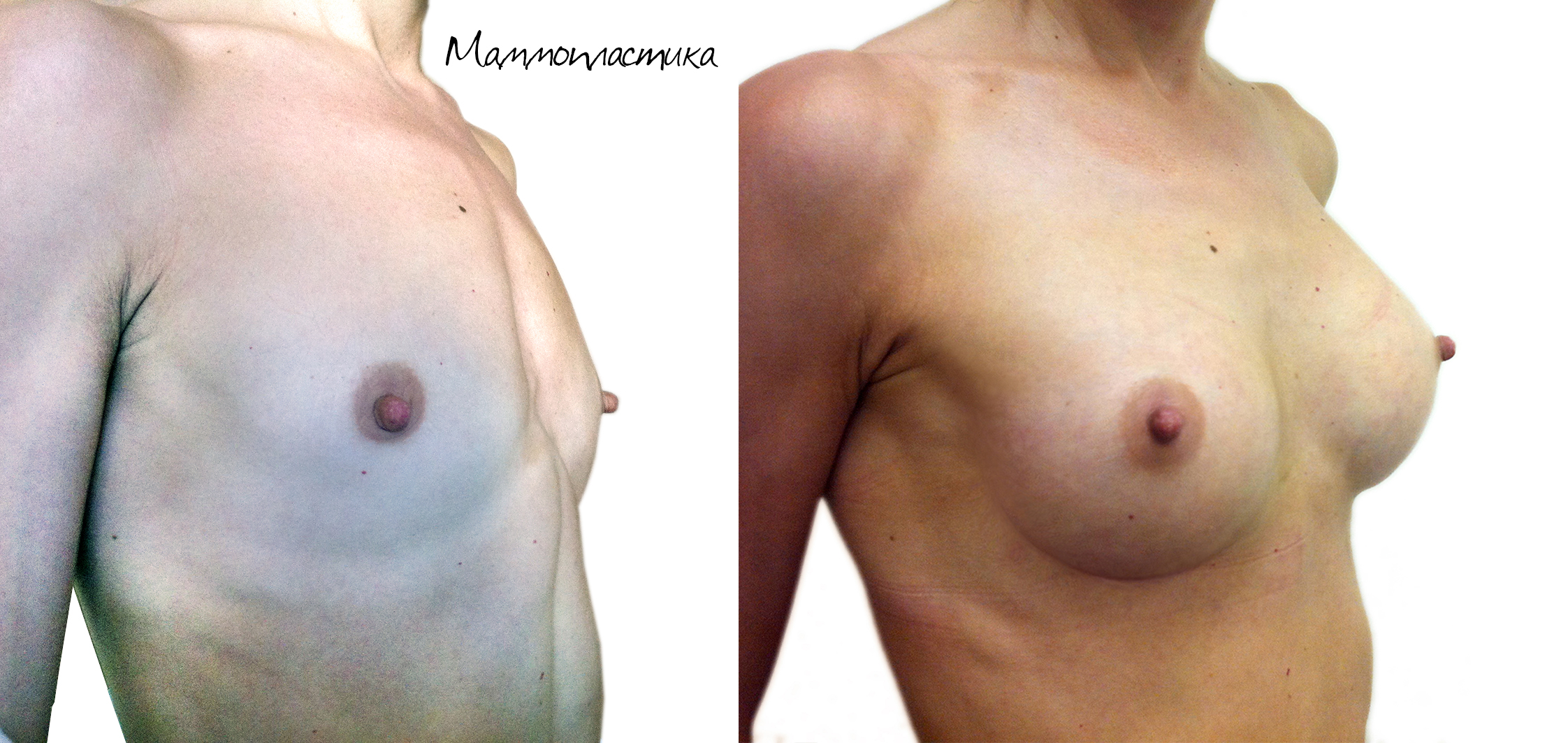 тубулярная деформация груди у женщин фото 94